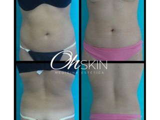Criolipolisis