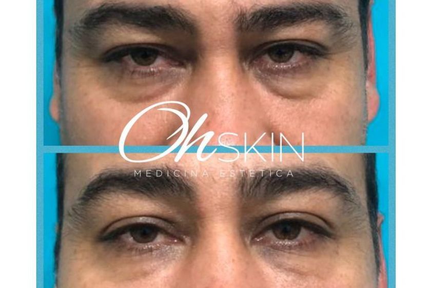 Tratamiento de bolsas en los ojos antes y después - 645777
