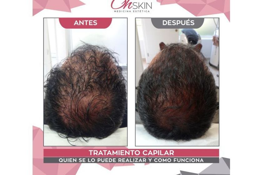 Implante Capilar antes y después - 645787