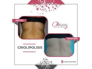 Criolipolisis