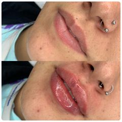 Aumento de labios - Dra. Enrileidis Rodríguez