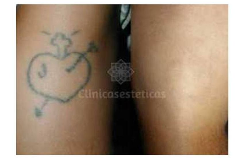 Borrar tatuajes antes y después - 576684