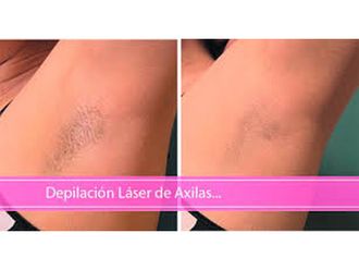 Depilación Láser antes y después - 646910