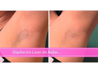 Depilación láser