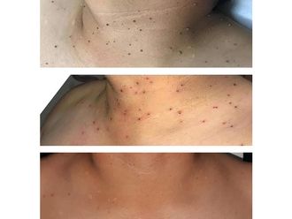 Verrugas - 646913