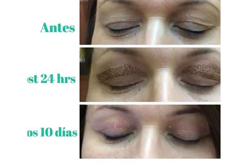 Blefaroplastía antes y después - 662533