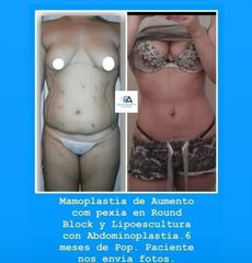 Aumento mamario - Clínica Estética Avanzar