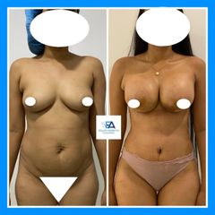 Aumento mamario - Clínica Estética Avanzar