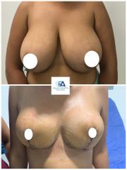 Reducción mamaria - Clínica Estética Avanzar