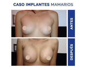 Aumento mamario - Clínica Estética Avanzar