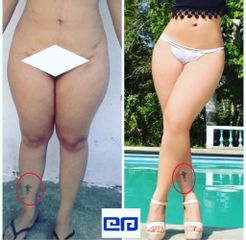 Liposucción - Clínica Estética Avanzar