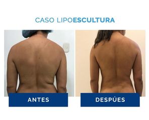 Liposucción - Clínica Estética Avanzar