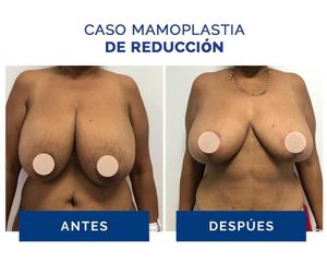 Reducción mamaria - Clínica Estética Avanzar