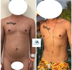 Liposucción - Clínica Estética Avanzar