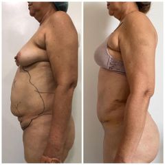 Abdominoplastia - Clínica Estética Avanzar