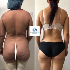 Liposucción - Clínica Estética Avanzar