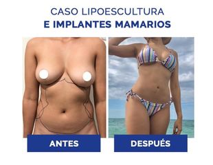 Liposucción - Clínica Estética Avanzar