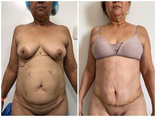 Abdominoplastia - Clínica Estética Avanzar
