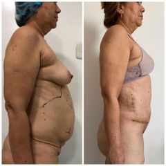 Abdominoplastia - Clínica Estética Avanzar