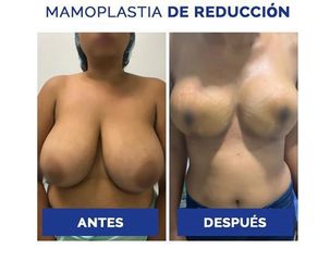 Reducción mamaria - Clínica Estética Avanzar