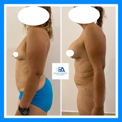 Liposucción - Clínica Estética Avanzar