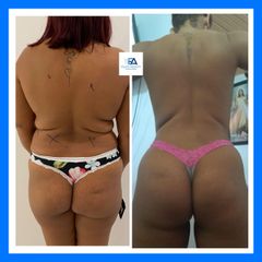 Abdominoplastia - Clínica Estética Avanzar