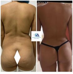Liposucción - Clínica Estética Avanzar