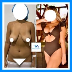 Lipoescultura - Clínica Estética Avanzar