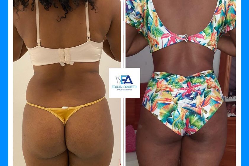 Liposucción antes y después - 790163
