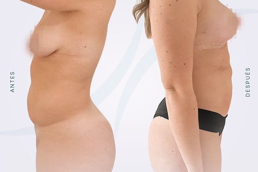 Liposucción antes y después - 845739