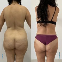 Liposucción - Dr. Nicolás Flores Moltedo