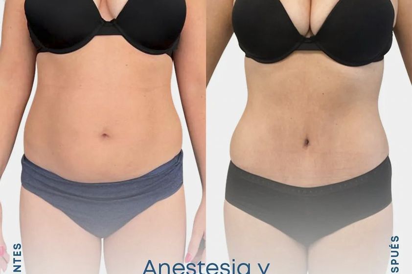 Liposucción antes y después - 845741