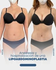 Liposucción - Dr. Nicolás Flores Moltedo