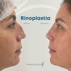 Rinoplastia - Dr. Nicolás Flores Moltedo