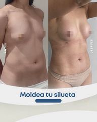 Aumento mamario - Dr. Nicolás Flores Moltedo