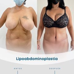 Lipoabdomindoplastia - Dr. Nicolás Flores Moltedo