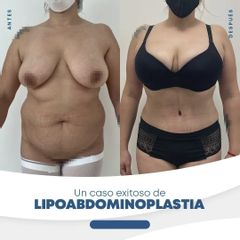 Lipoabdomindoplastia - Dr. Nicolás Flores Moltedo