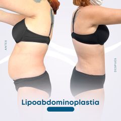 Lipoabdomindoplastia - Dr. Nicolás Flores Moltedo