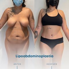 Lipoabdomindoplastia - Dr. Nicolás Flores Moltedo