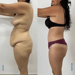 Abdominoplastia - Dr. Nicolás Flores Moltedo