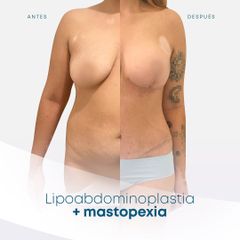 Lipoescultura - Dr. Nicolás Flores Moltedo