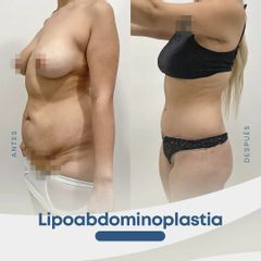 Lipoabdomindoplastia - Dr. Nicolás Flores Moltedo