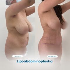 Lipoabdomindoplastia - Dr. Nicolás Flores Moltedo