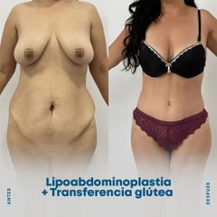 Lipoabdomindoplastia - Dr. Nicolás Flores Moltedo