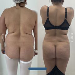 Liposucción - Dr. Nicolás Flores Moltedo