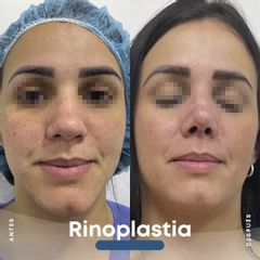 Rinoplastia - Dr. Nicolás Flores Moltedo