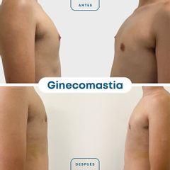 Ginecomastia - Dr. Nicolás Flores Moltedo