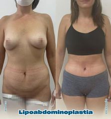 Lipoabdominoplastia - Dr. Nicolás Flores Moltedo