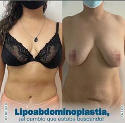 Lipoabdominoplastia - Dr. Nicolás Flores Moltedo