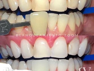 Blanquear dientes - 853116